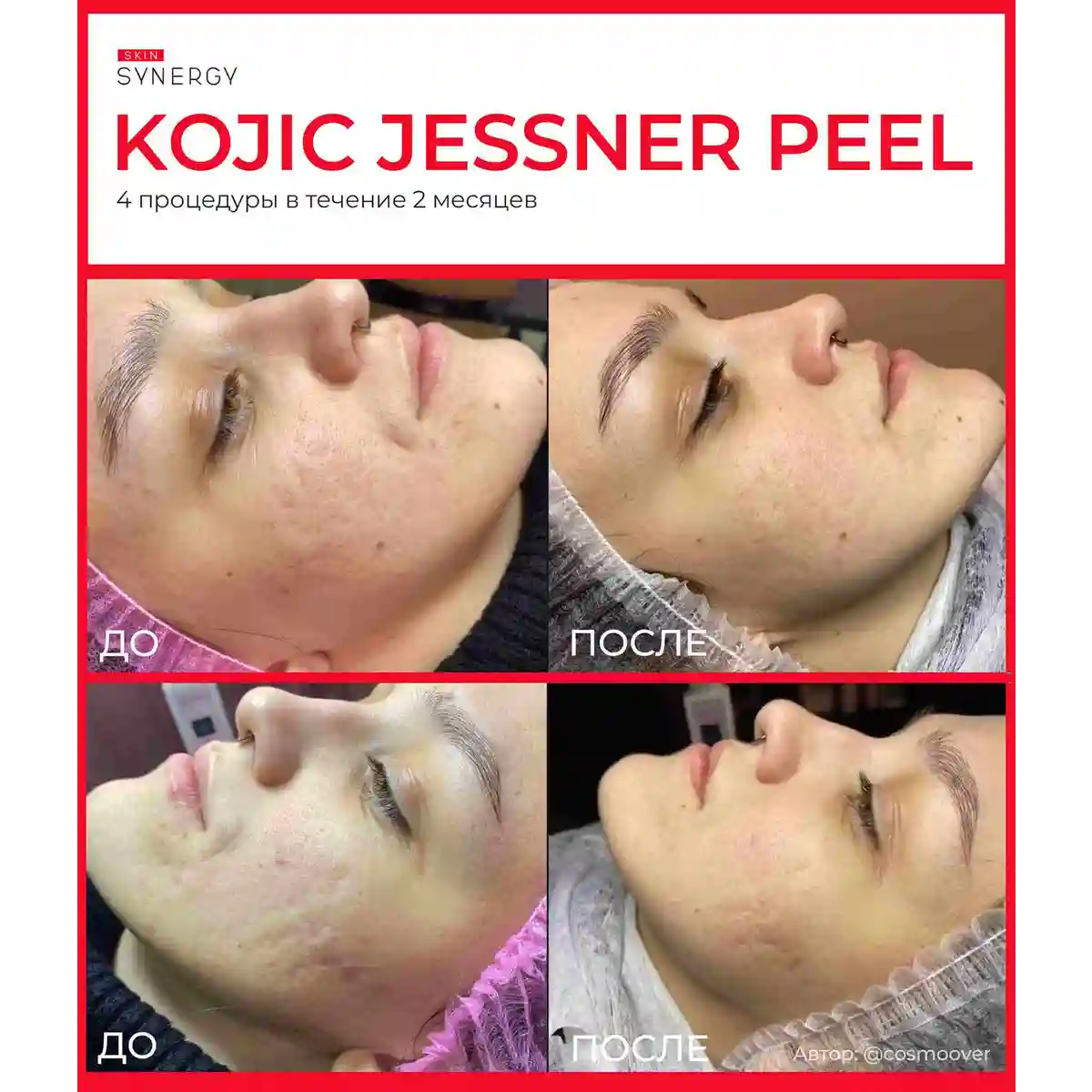 Купить Пилинг Джесснера с койевой кислотой KOJIC JESSNER PEEL, 30 мл Skin Synergy Пилинг Джесснера с койевой кислотой KOJIC JESSNER PEEL, 30 мл