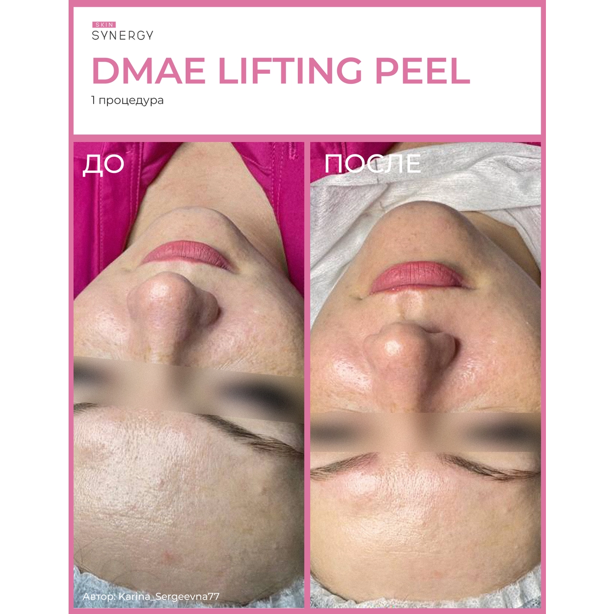 Skin Synergy Пилинг ДМАЭ лифтинг, DMAE LIFTING PEEL, 30 мл