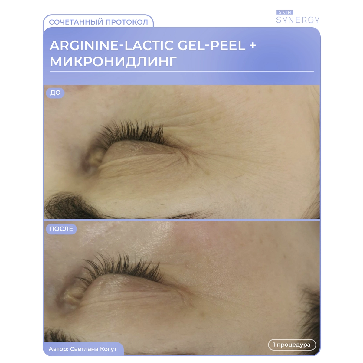 Купить Пилинг Аргининово-молочный гелевый, ARGININE-LACTIC GEL-PEEL, 30 мл Skin Synergy Пилинг Аргининово-молочный гелевый, ARGININE-LACTIC GEL-PEEL, 30 мл
