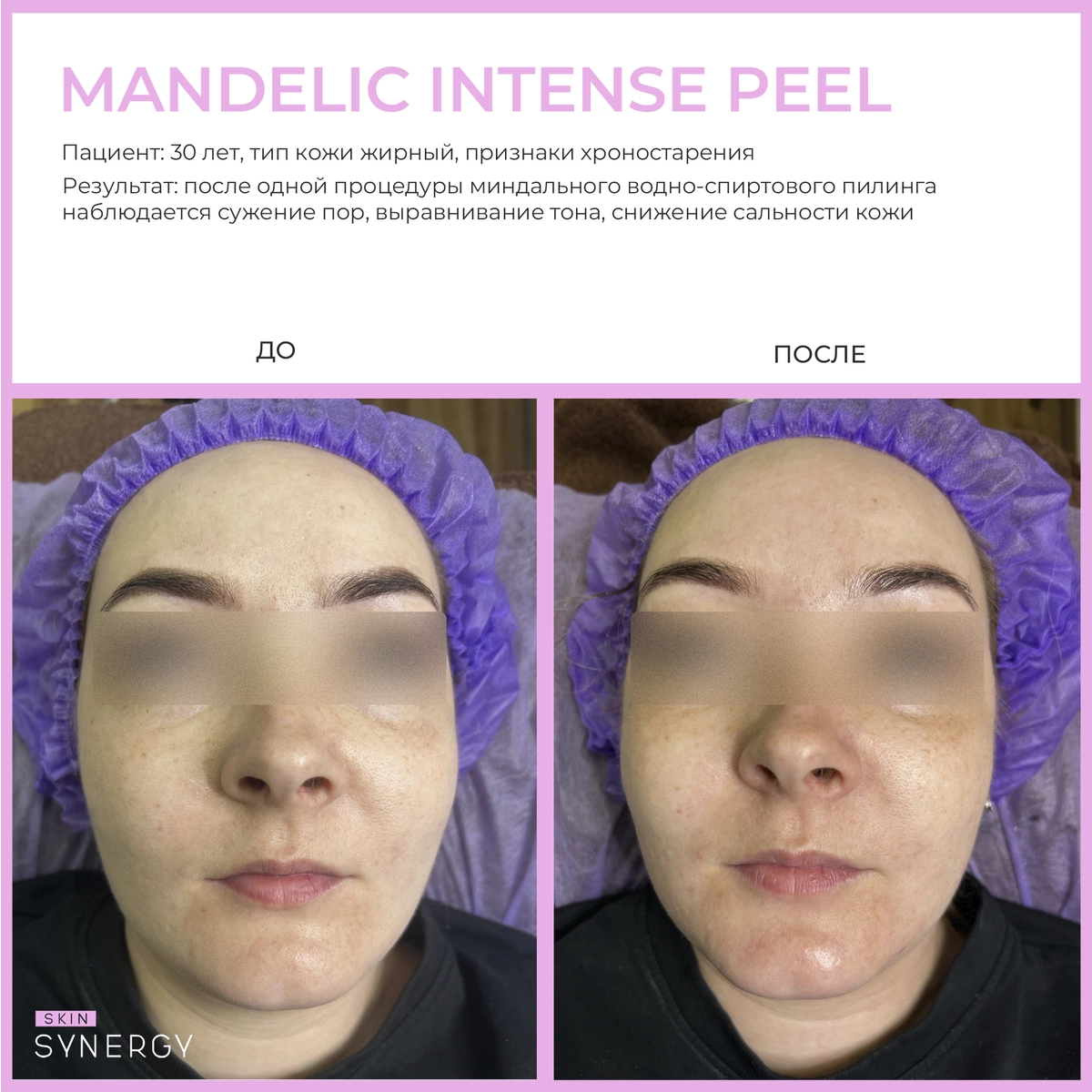 Купить Пилинг миндальный Интенс, MANDELIC INTENSE PEEL, 30 мл Skin Synergy Пилинг миндальный Интенс, MANDELIC INTENSE PEEL, 30 мл