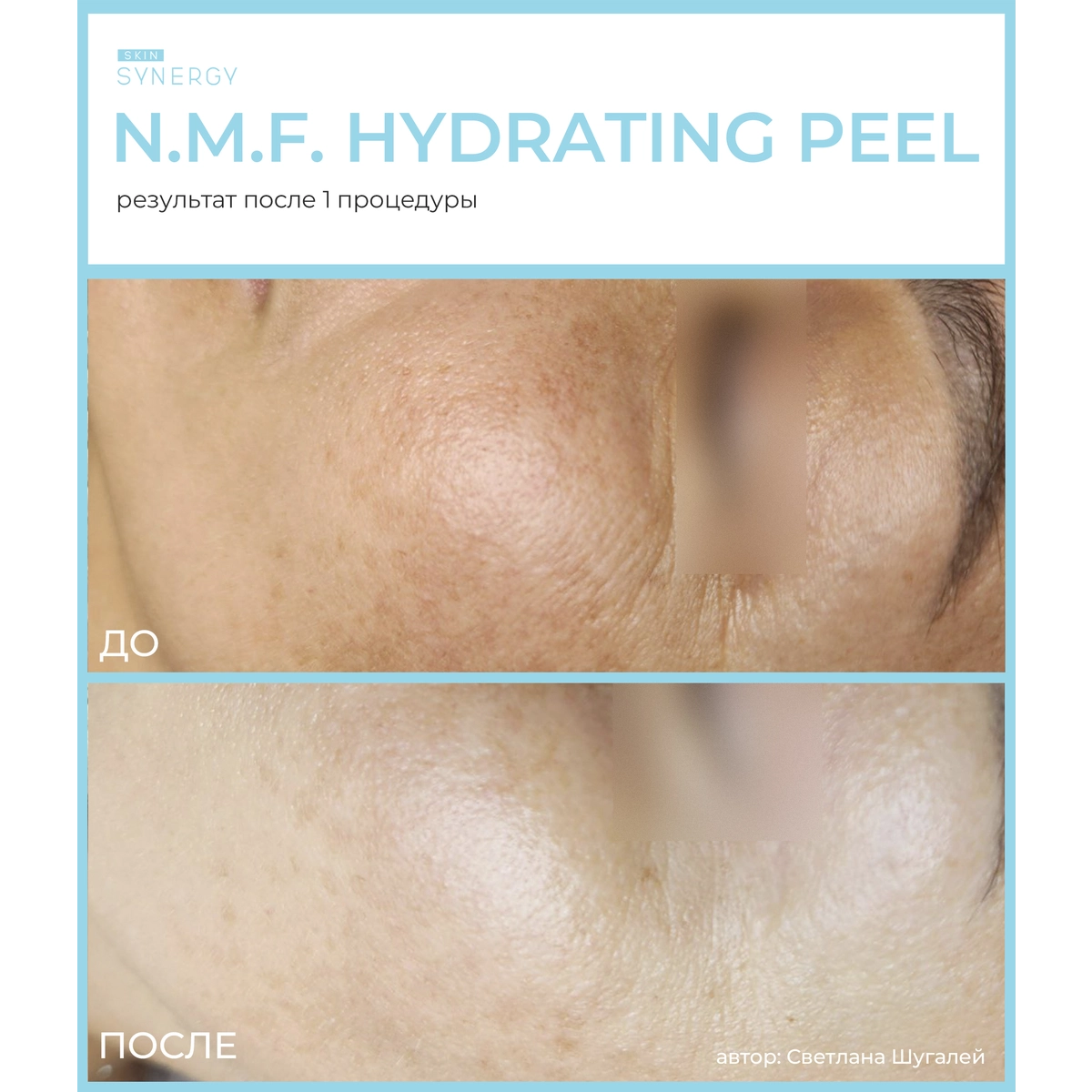 Skin Synergy Пилинг увлажняющий с НФМ, N.F.M HYDRATINGF PEEL, 30 мл